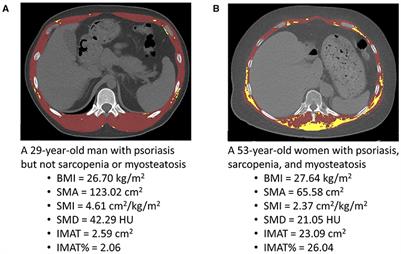 Psoriasis Is Associated With Myosteatosis but Not Sarcopenia: A Case-Control Study